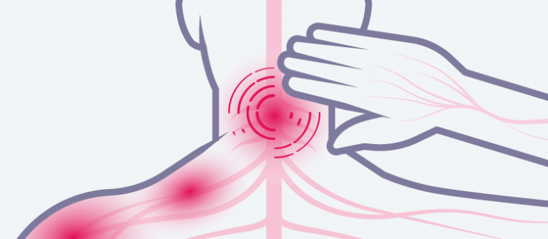 Aanhoudende pijn na gordelroos | Excellent Klinieken
